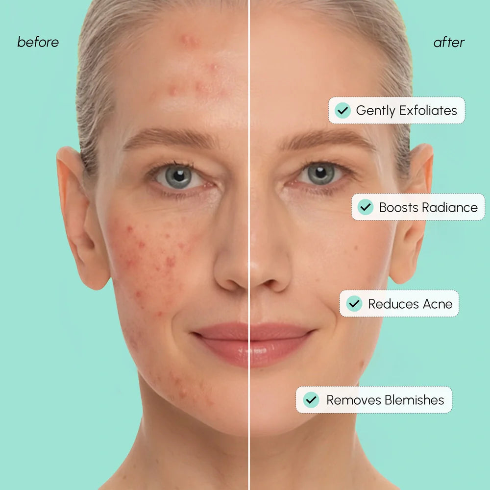 Azelaic Acid Soothing Pads - WONDERWALL