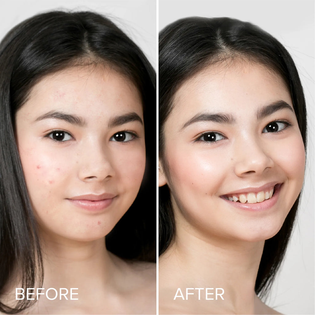 Pimple & Acne Patches - WONDERWALL