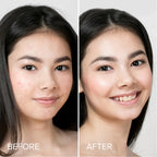 Pimple & Acne Patches - WONDERWALL