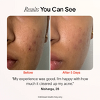 Bye Acne: 3-Minute Pimple Spot Treatment - WONDERWALL