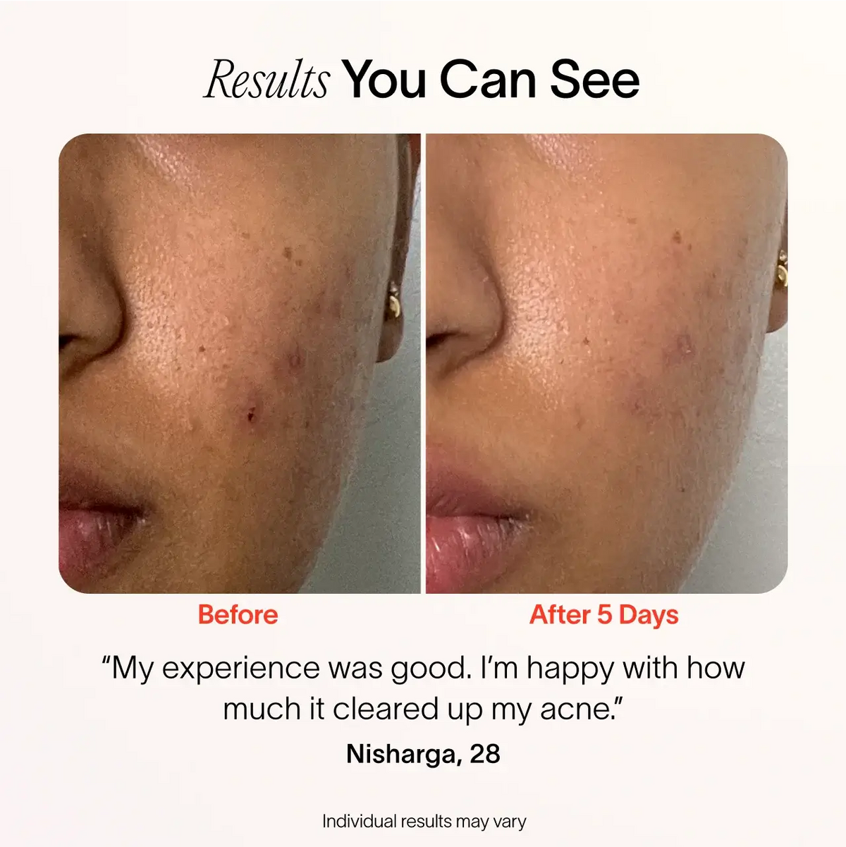 Bye Acne: 3-Minute Pimple Spot Treatment - WONDERWALL
