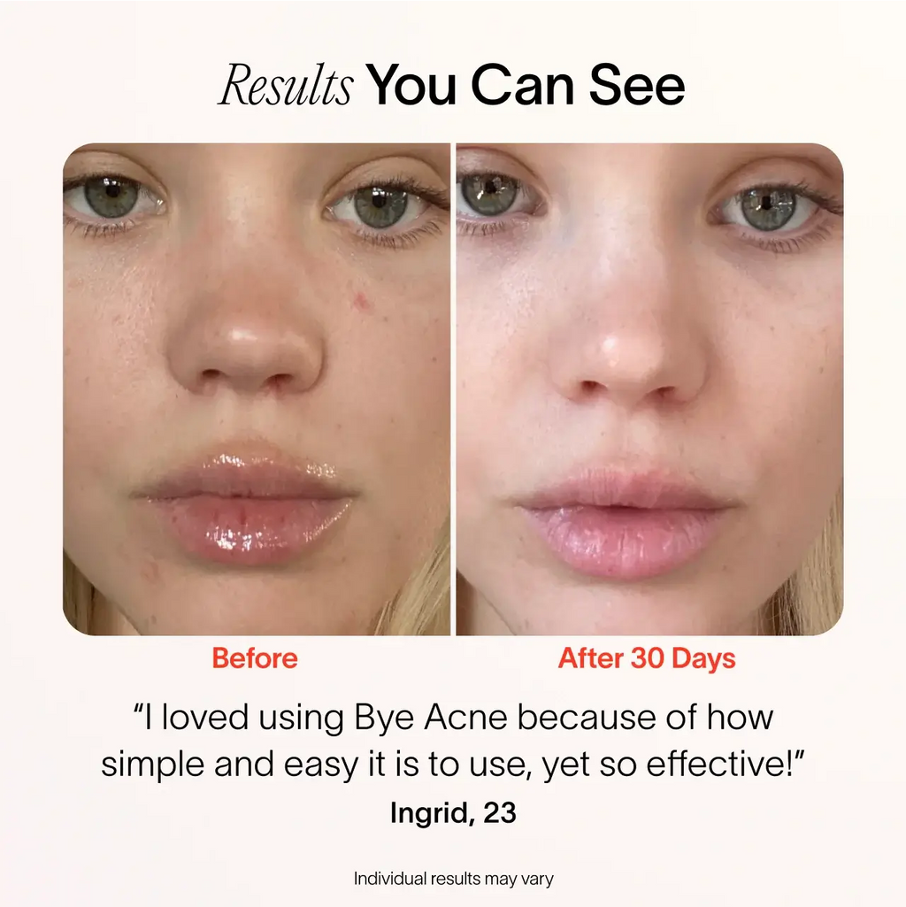 Bye Acne: 3-Minute Pimple Spot Treatment - WONDERWALL