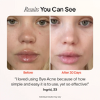 Bye Acne: 3-Minute Pimple Spot Treatment - WONDERWALL